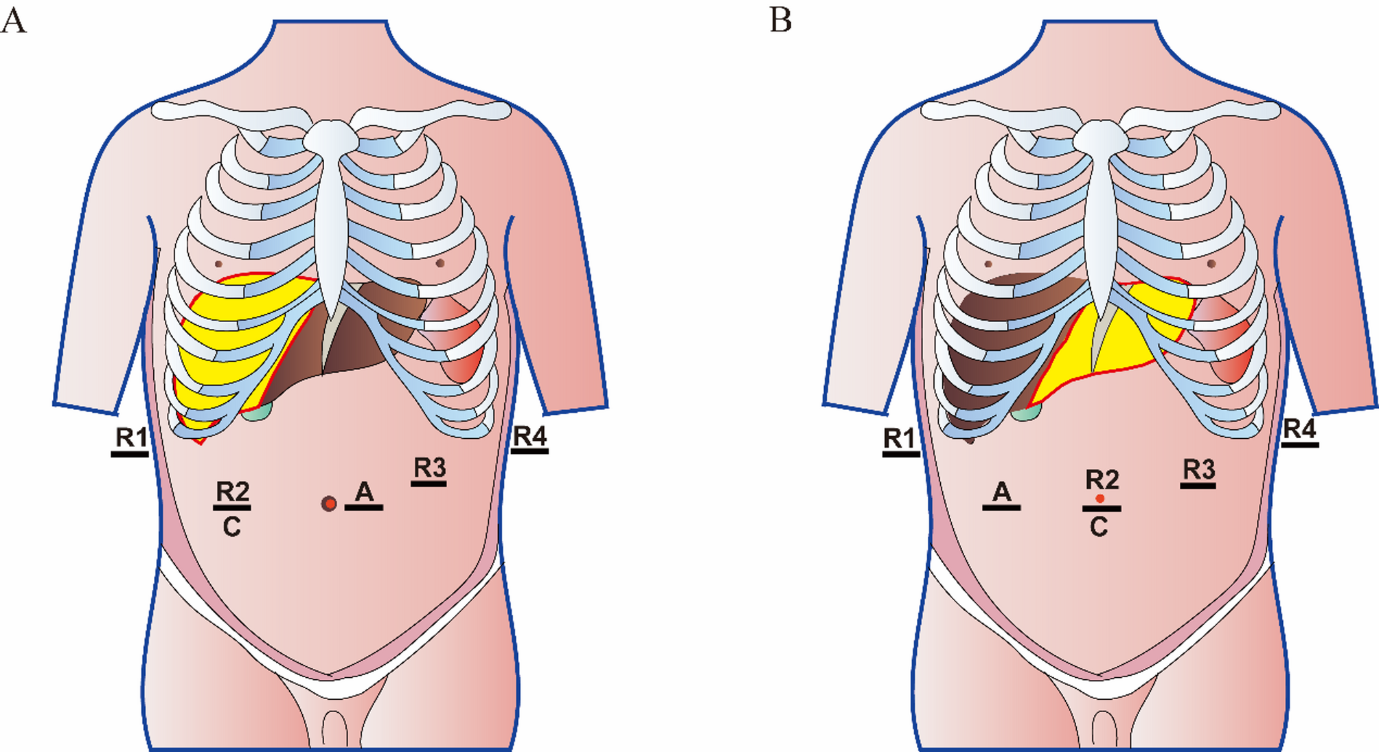 Robotic versus open hepatectomy for large(≥ 5 cm) hepatocellular carcinoma: A large volume center, propensity score matched study