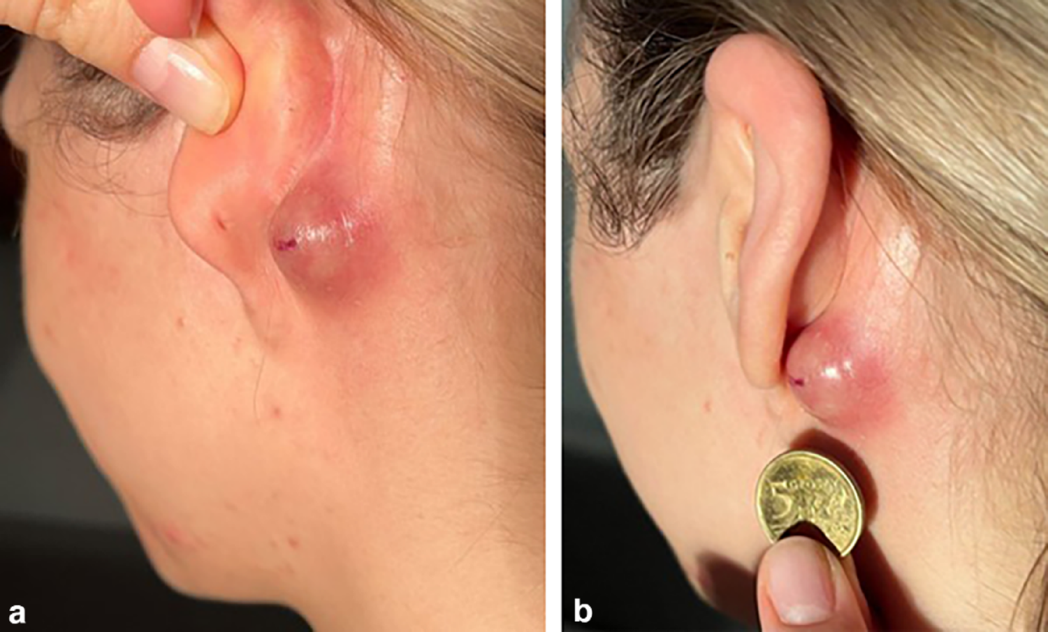 Friend or foe? Sebaceous cyst inflammation during ixekizumab therapy in psoriatic arthritis: case based review