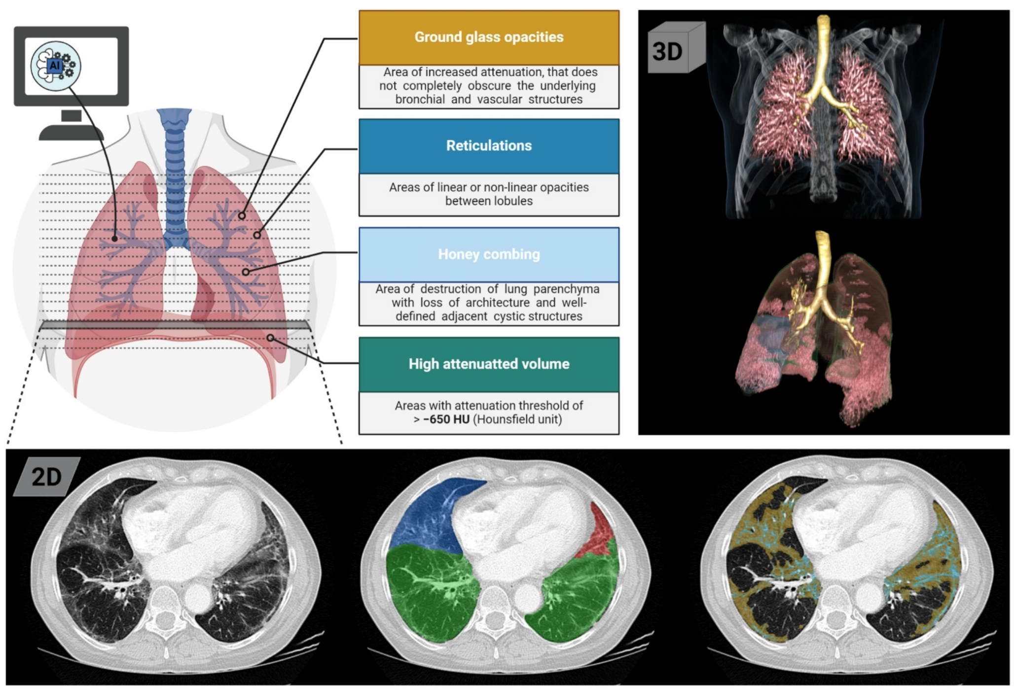 The association of symptoms, pulmonary function test and computed tomography in interstitial lung disease at the onset of connective tissue disease: an observational study with artificial intelligence analysis of high-resolution computed tomography