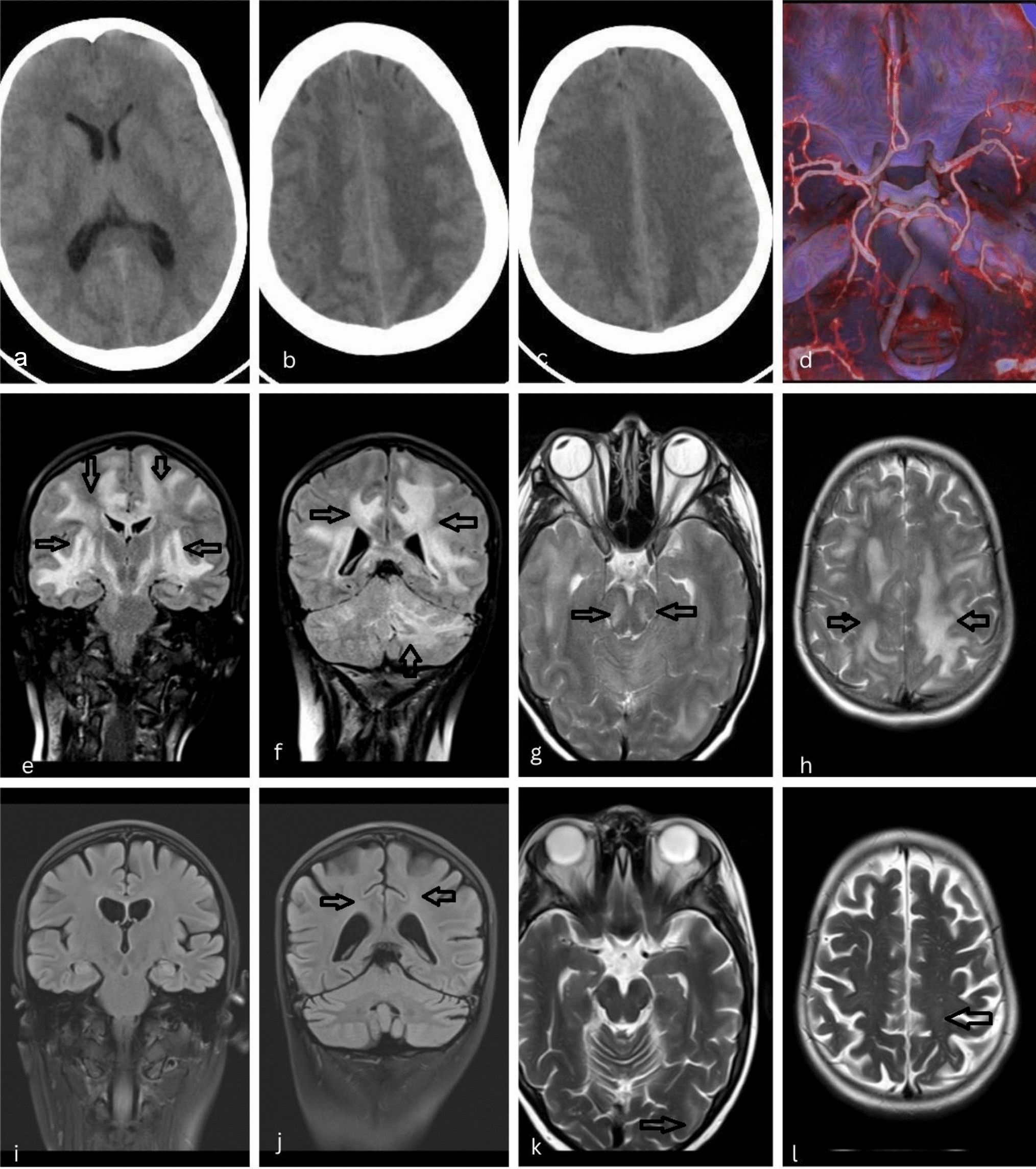 Multiphasic acute disseminated encephalomyelitis (MDEM) in a patient with systemic lupus erythematosus and C4A deficiency: case-based review