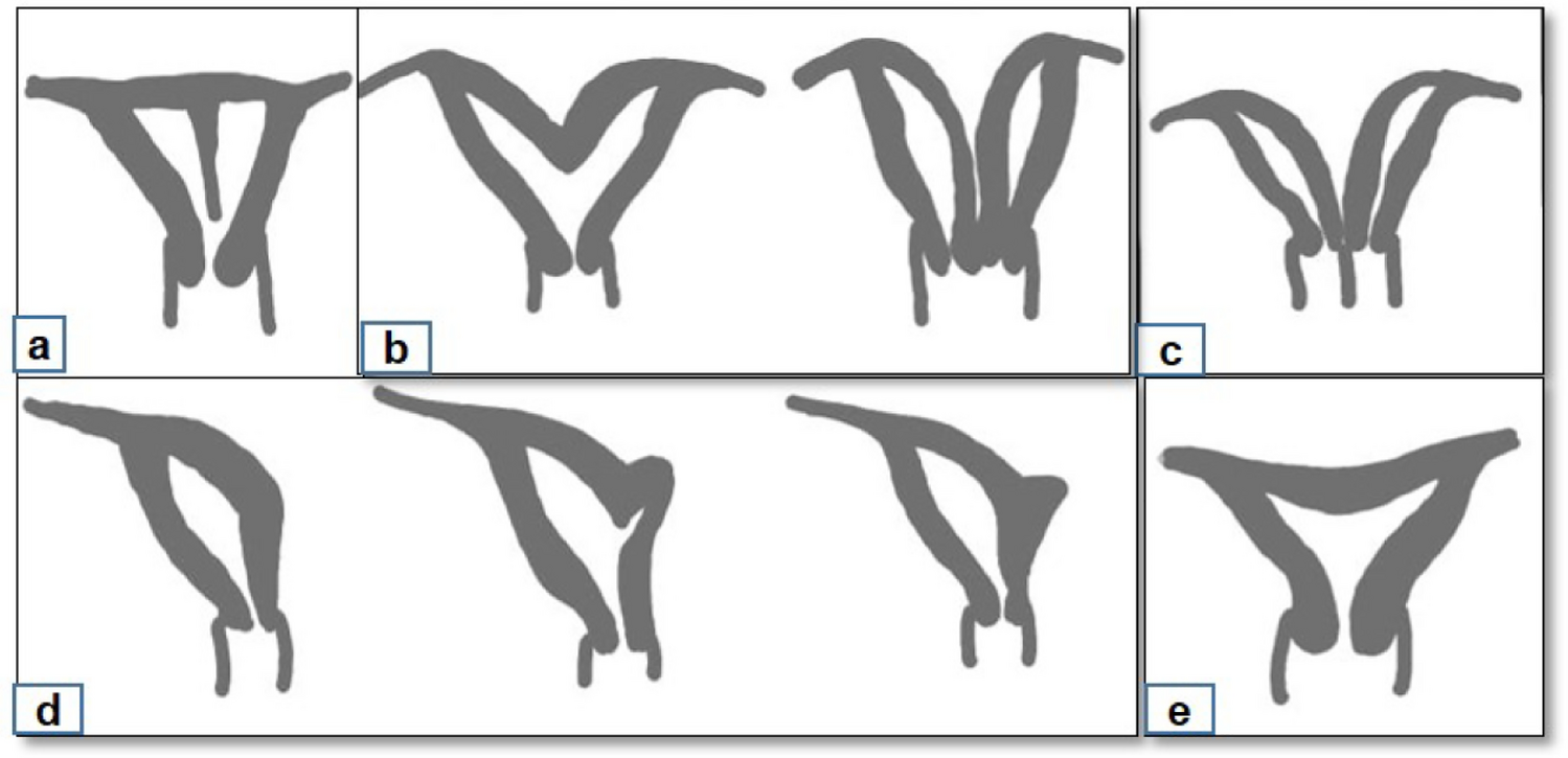 Navigating Anatomical Challenges in Brachytherapy in Cervical Cancer Patients with Uterine Anomalies: A Narrative Review