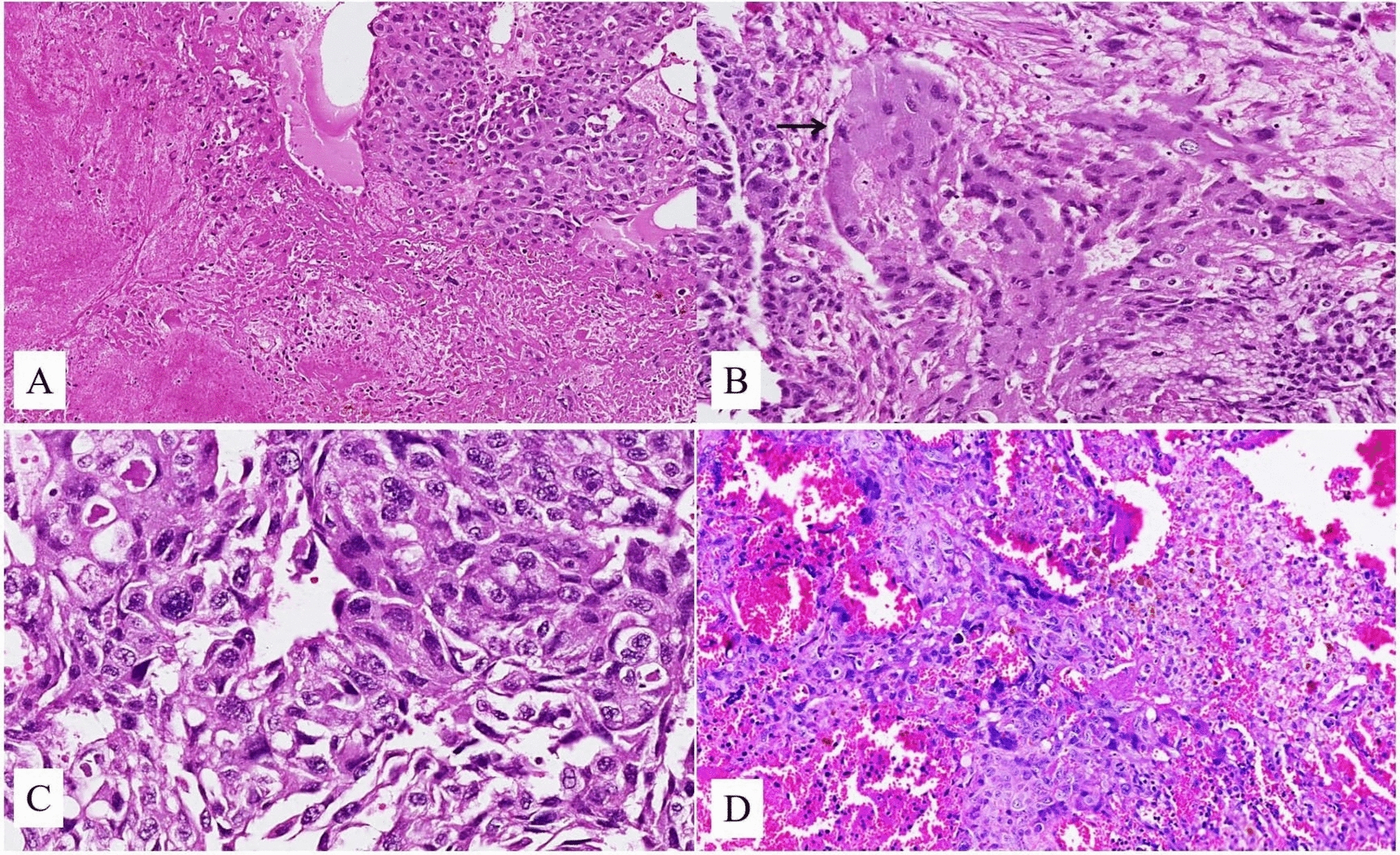 Clinicopathological insights into gestational trophoblastic neoplasia: a tertiary care center experience