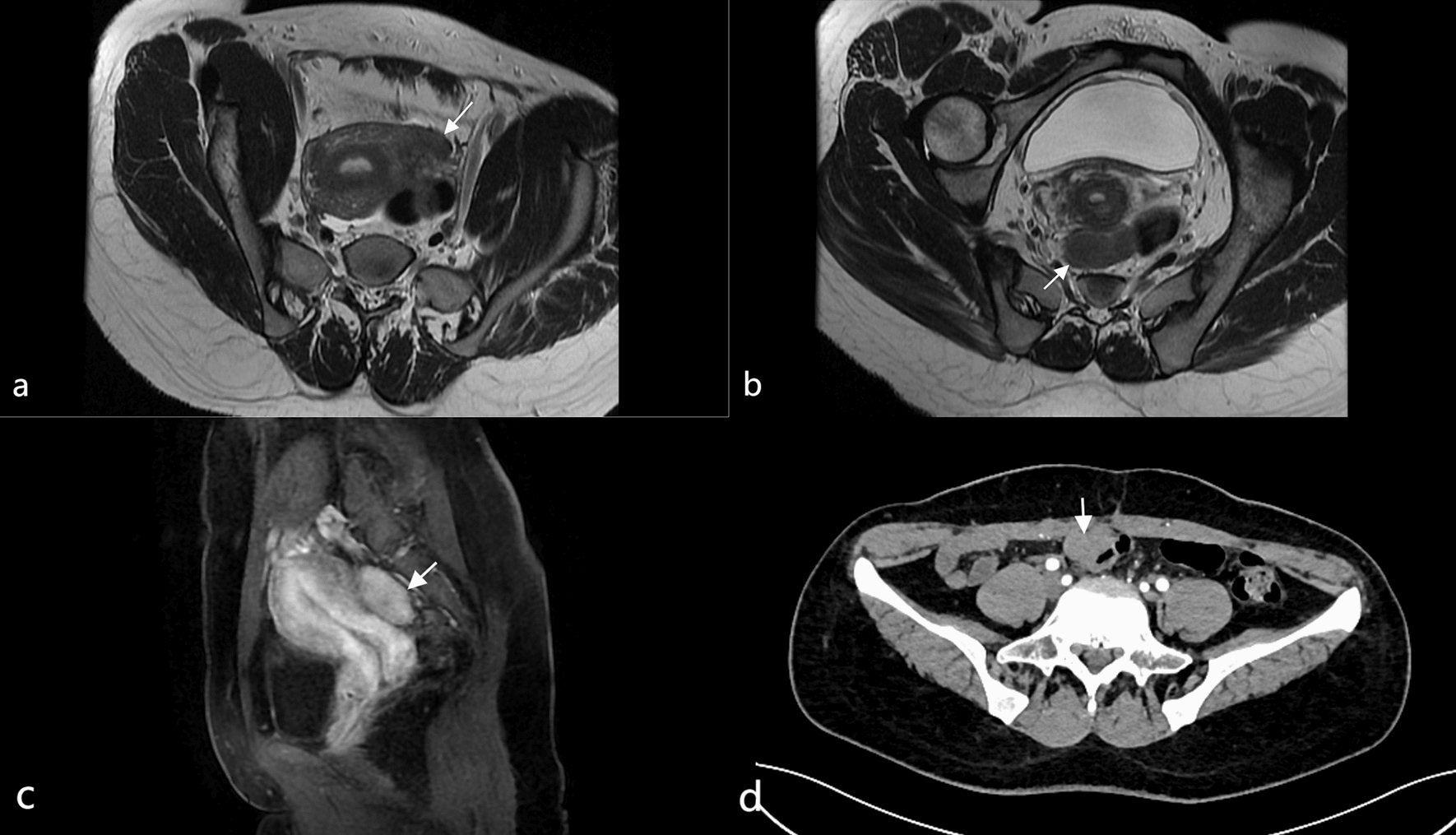 Disseminated Peritoneal Leiomyomatosis: A Rare Cause of Abdominal Masses and Its Imaging Characteristics