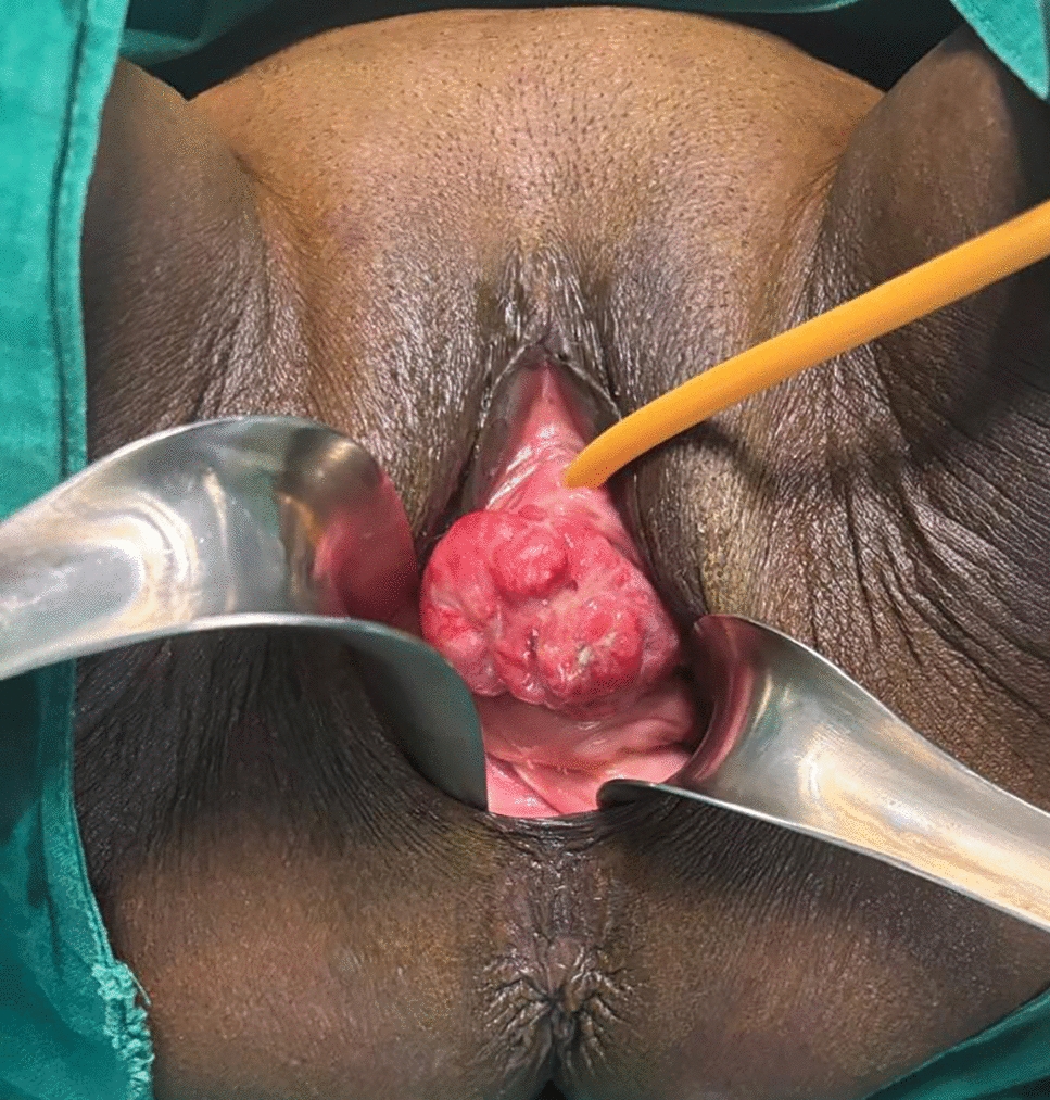 Vaginal Leiomyosarcoma: A Case Report and Literature Review