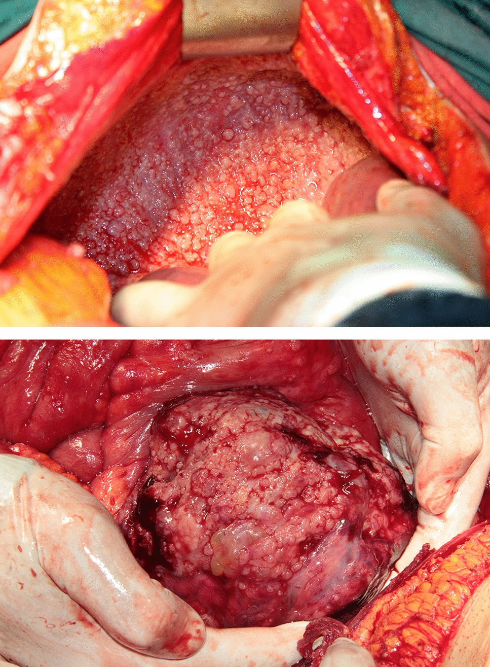 Can Peritoneal Cancer Index be Determined in F-FDG PET/CT Before Surgery in Ovarian Peritoneal Carcinomatosis?