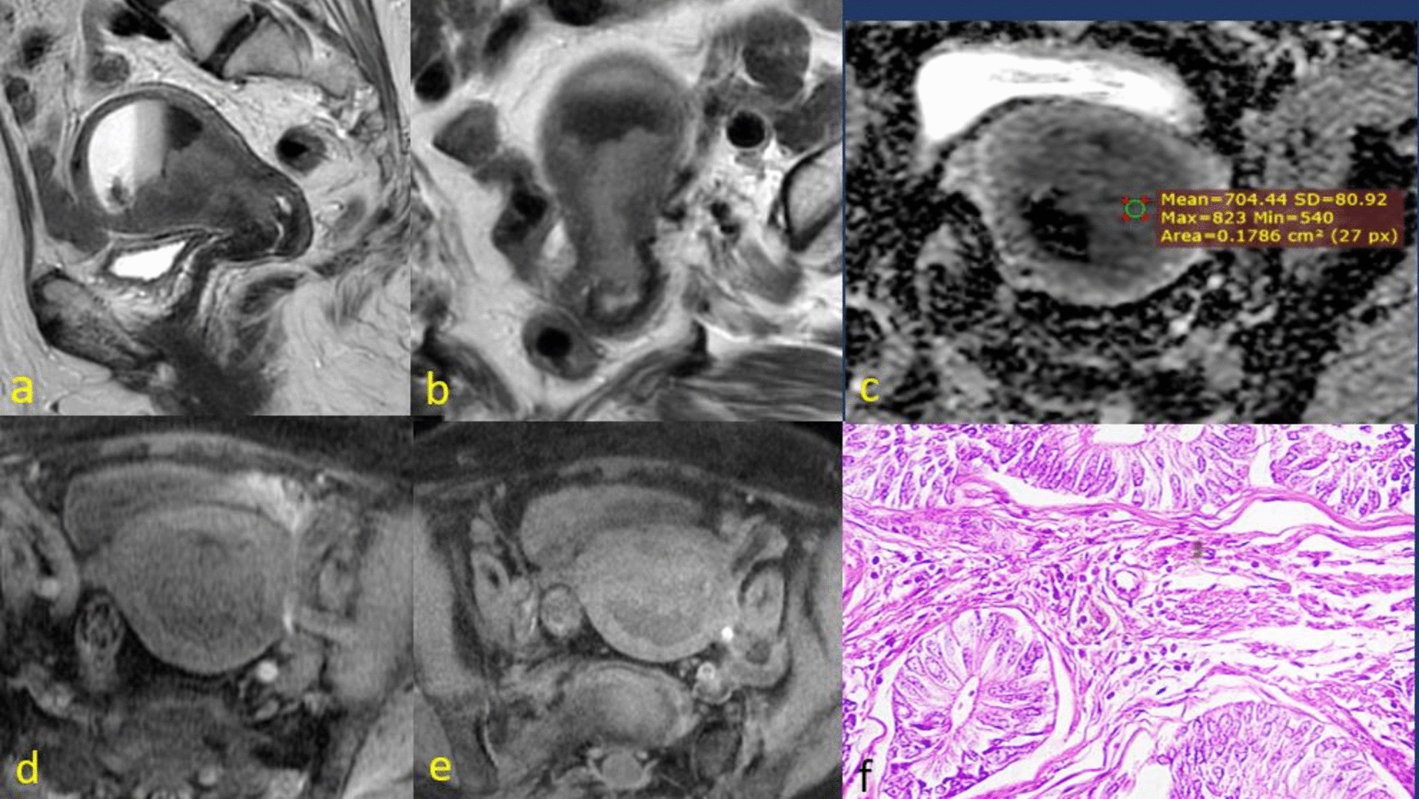 Differentiating Endometrial vs Endocervical Carcinoma: MRI-Based Case Review