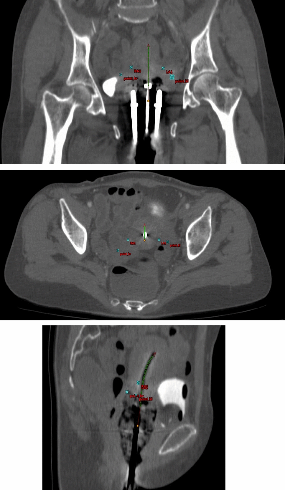 Comparison of Applicator-Based Point A and Anatomical Point A in Terms of Position and Dosimetry in Intracavitary Brachytherapy (ICBT) for Carcinoma Cervix Patients