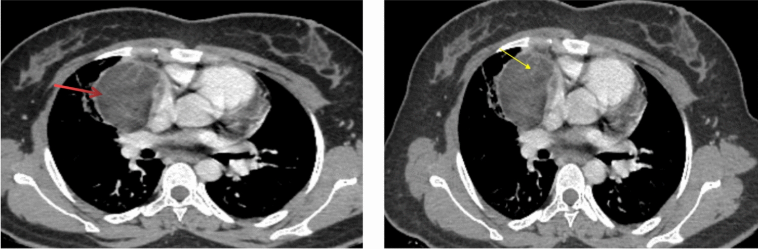 Concurrent Mediastinal and Ovarian Mature Teratoma: a Diagnostic Hunt