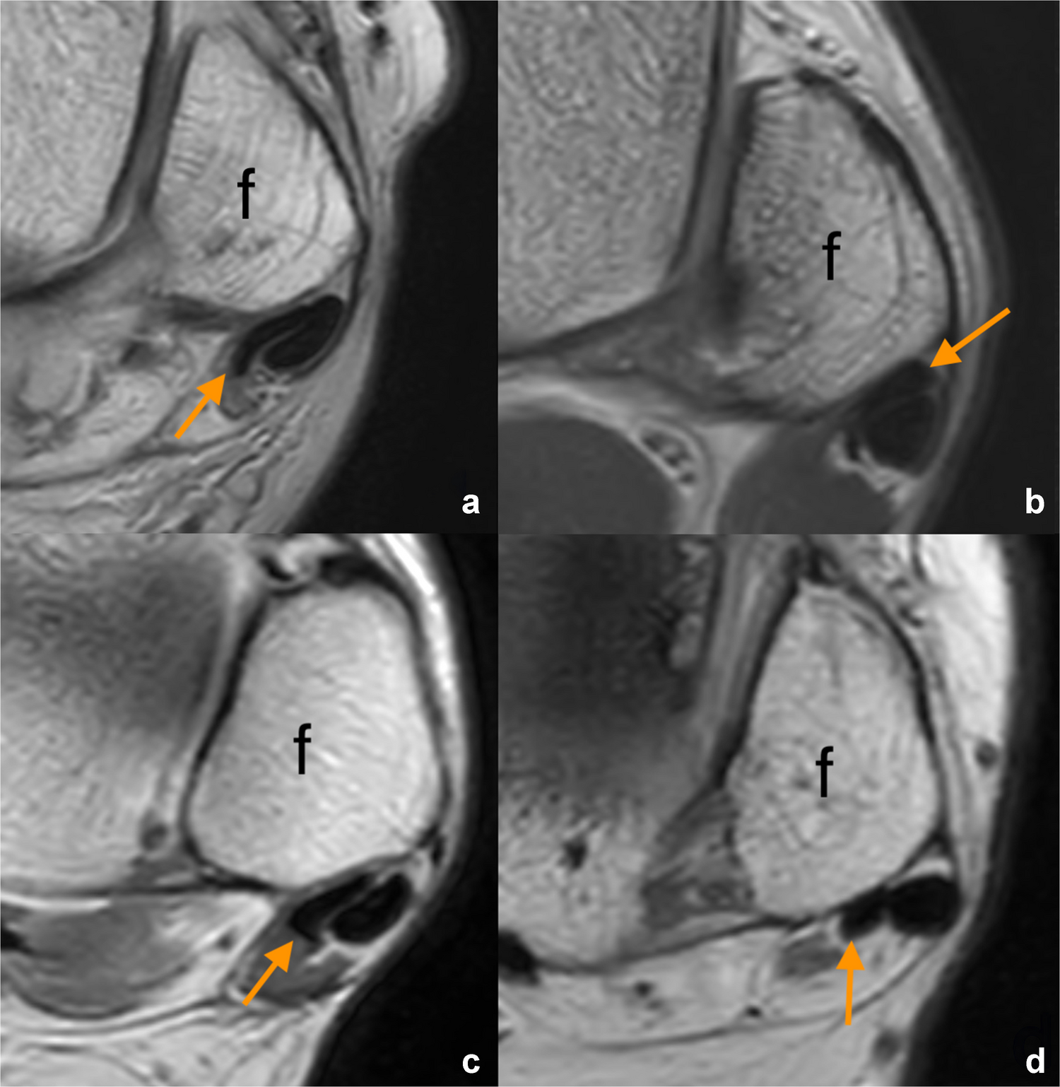 Validation of an MRI-based classification of peroneus brevis tendon morphology: a four-type system with high inter-rater reliability