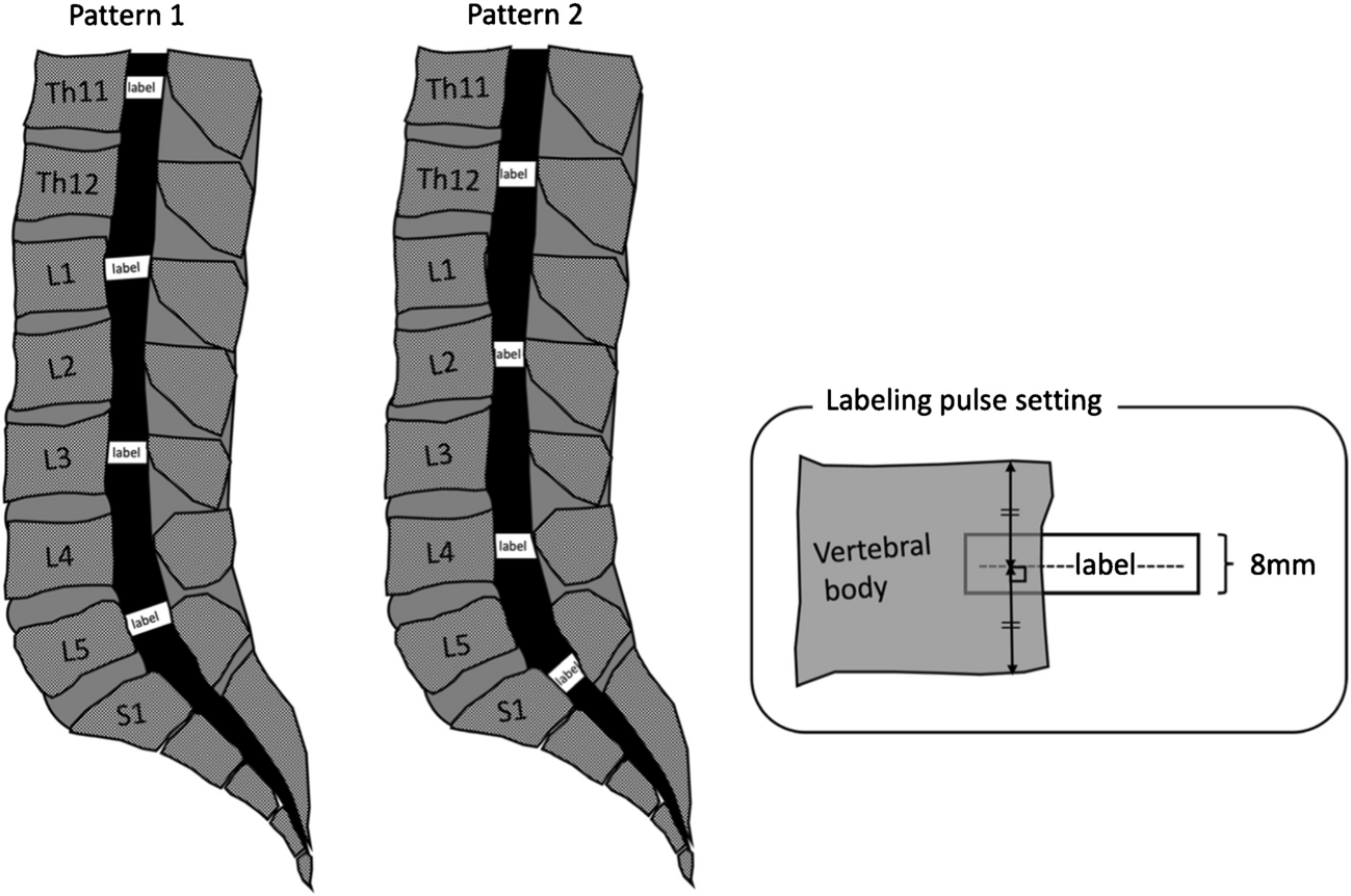 Dynamic analysis of lumbar spine cerebrospinal fluid flow during deep respiration using a modified time–spatial labeling inversion pulse: technical feasibility in a healthy volunteer
