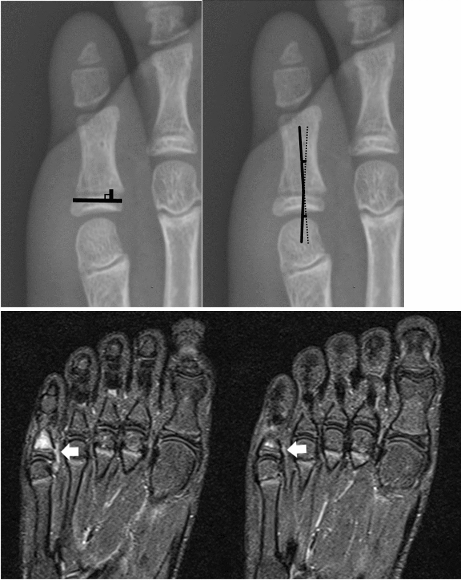 Diagnostic values of radiographic indices for predicting periosteal entrapment in pediatric proximal phalangeal base physeal fractures of toes