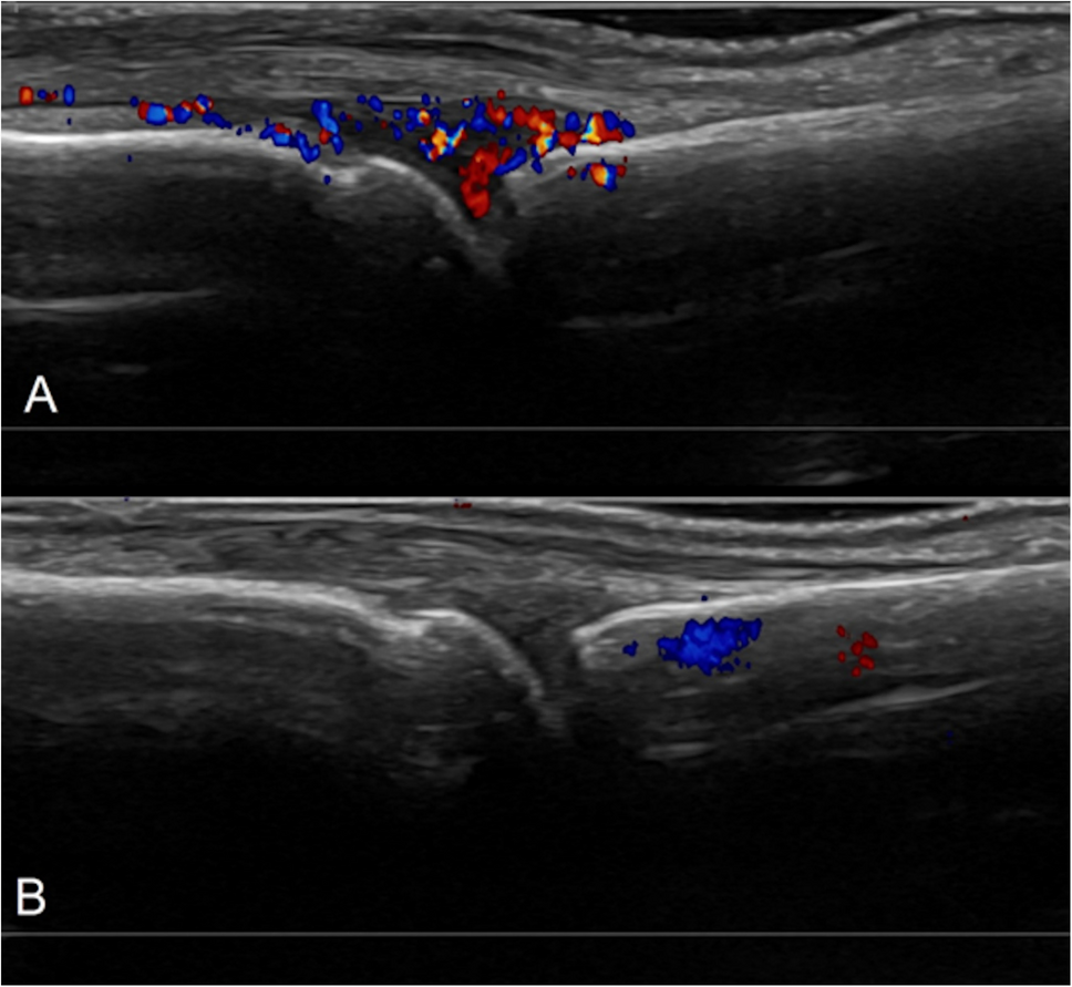 Imaging in clinical trials of rheumatoid arthritis: where are we in 2025?