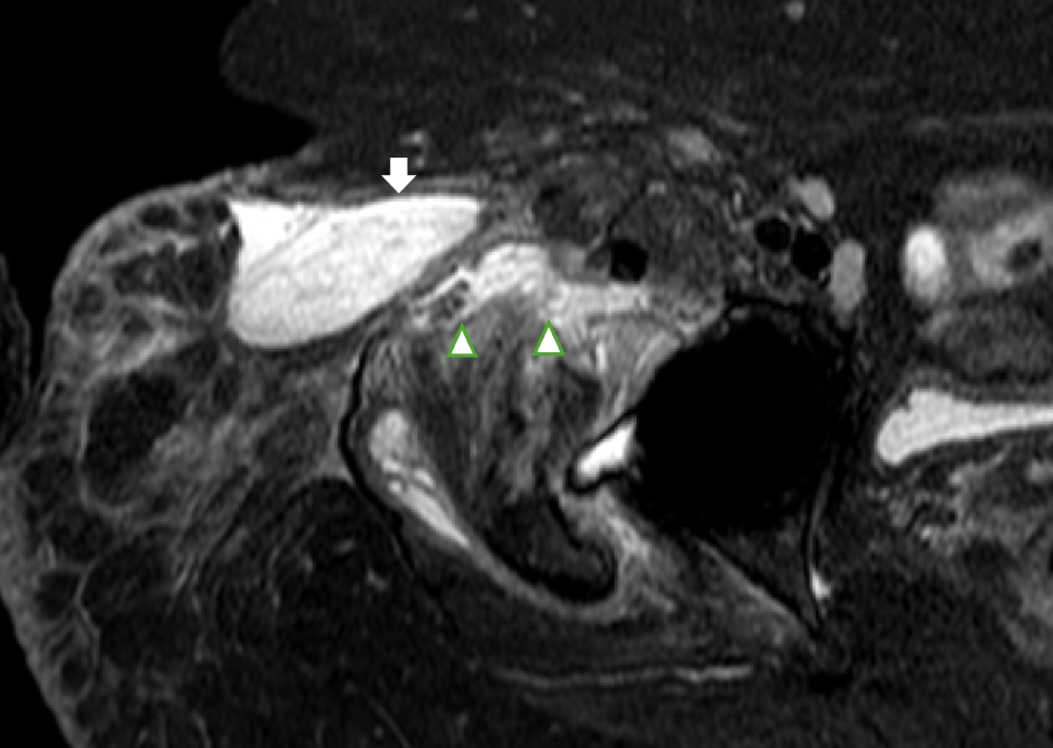 Imaging and image-guided intervention of septic arthritis in adults and children