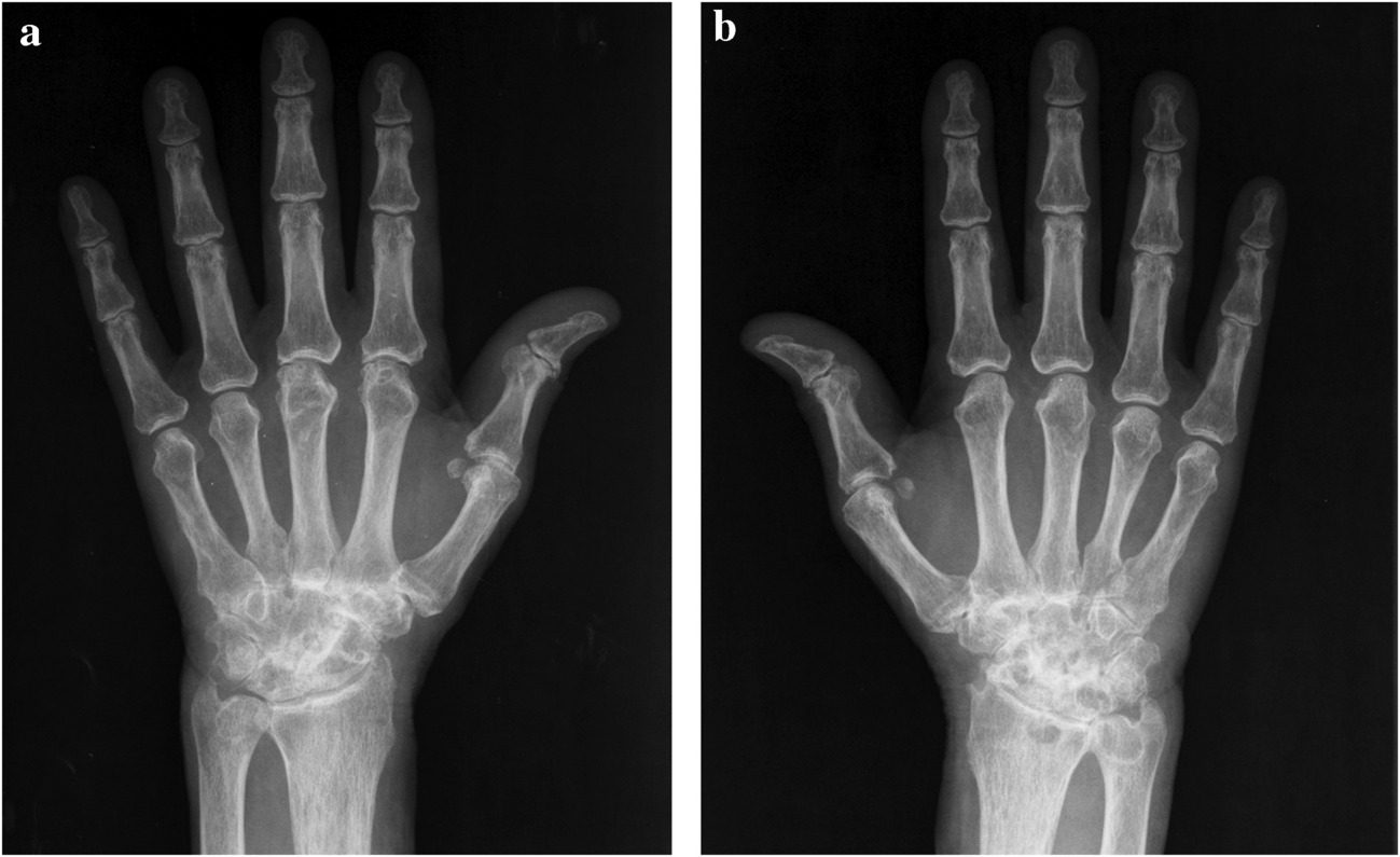 Spondylodiscitis revealing Whipple disease