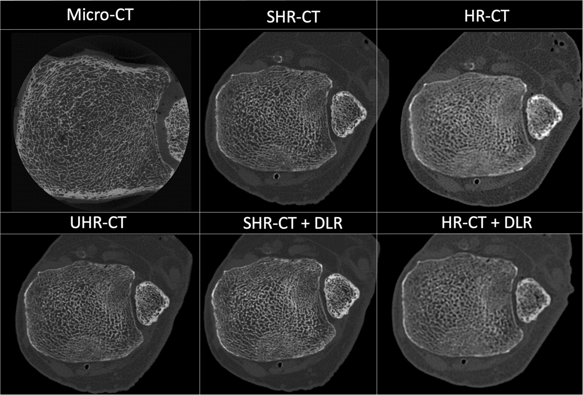 Trabecular bone analysis: ultra-high-resolution CT goes far beyond high-resolution CT and gets closer to micro-CT (a study using Canon Medical CT devices)