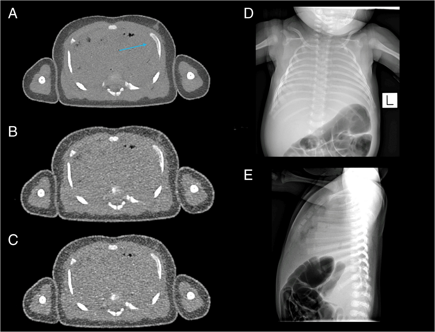 Evaluation of ultra-low and low-dose CT skeletal survey for fracture detection in assessments for suspected non-accidental injury: a prospective post-mortem study