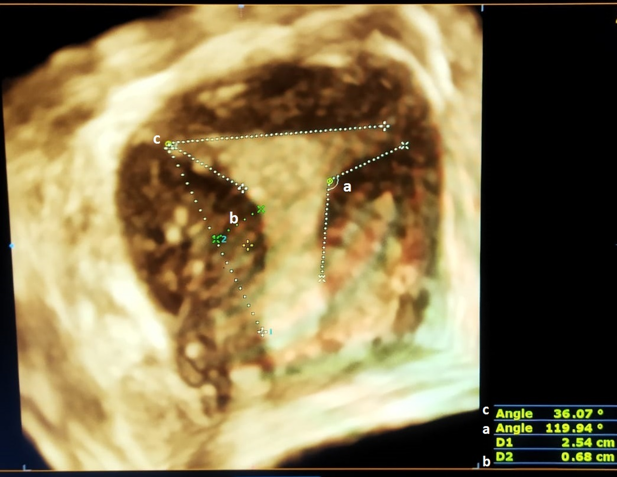Reproductive Performance and Obstetric Outcomes after Hysteroscopic Metroplasty for T Shaped Uterus