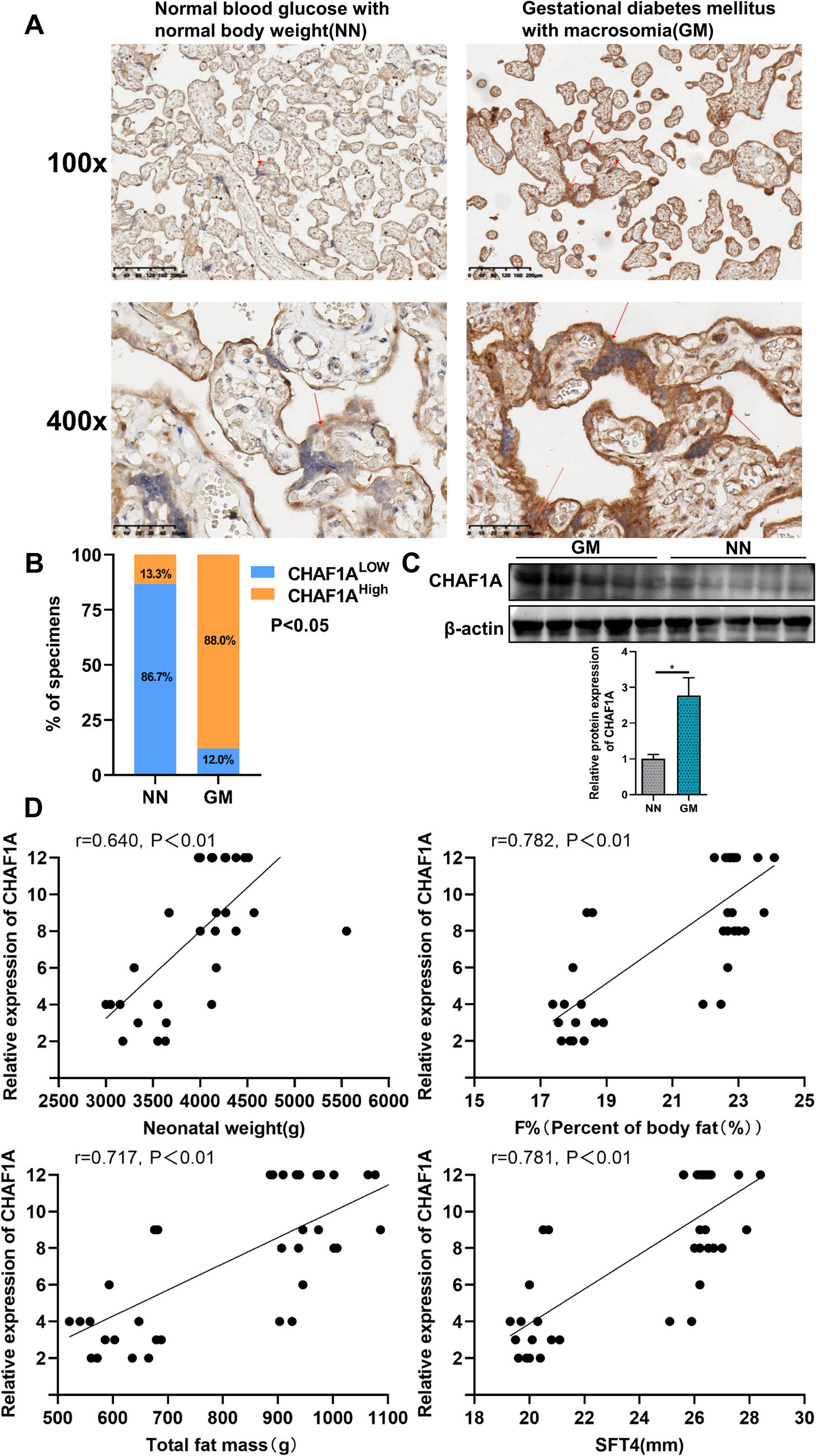 CHAF1A Promotes Preadipocyte Differentiation and Contributes to Macrosomia in Gestational Diabetes Mellitus