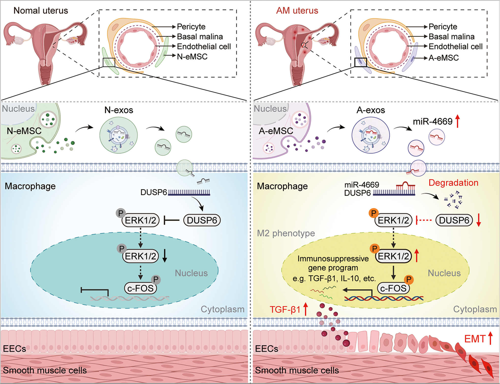 Endometrial Mesenchymal Stem Cell-Derived Exosomal miR-4669 Promotes EMT in Adenomyosis by Inducing M2 Macrophage Polarization via the DUSP6/ERK Pathway