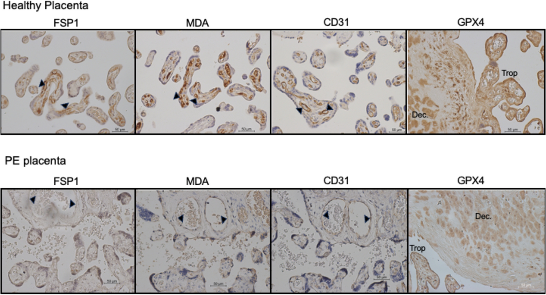 Preeclampsia is Associated with Altered Expression of Ferroptosis Biomarkers in Placental but not Maternal Vasculature