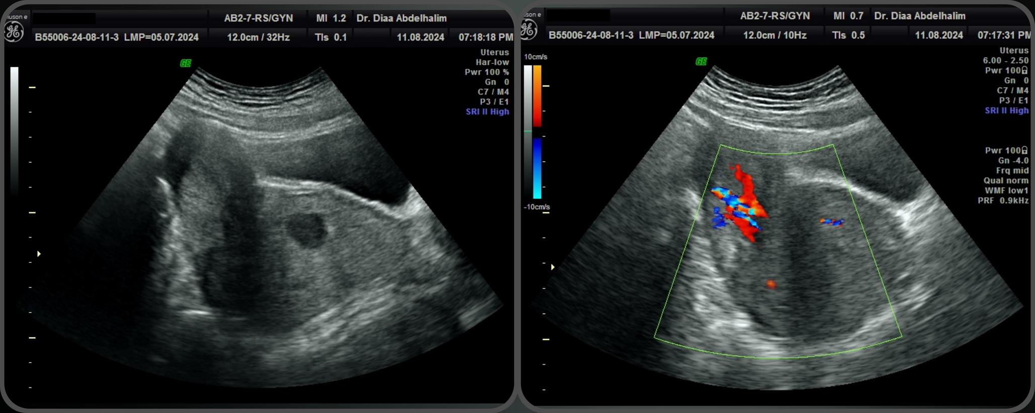Transhymenal Vaginoscopic Resection of a Large Polypoid Cervical Endometriosis in an Adolescent Girl: Case Report and Literature Review