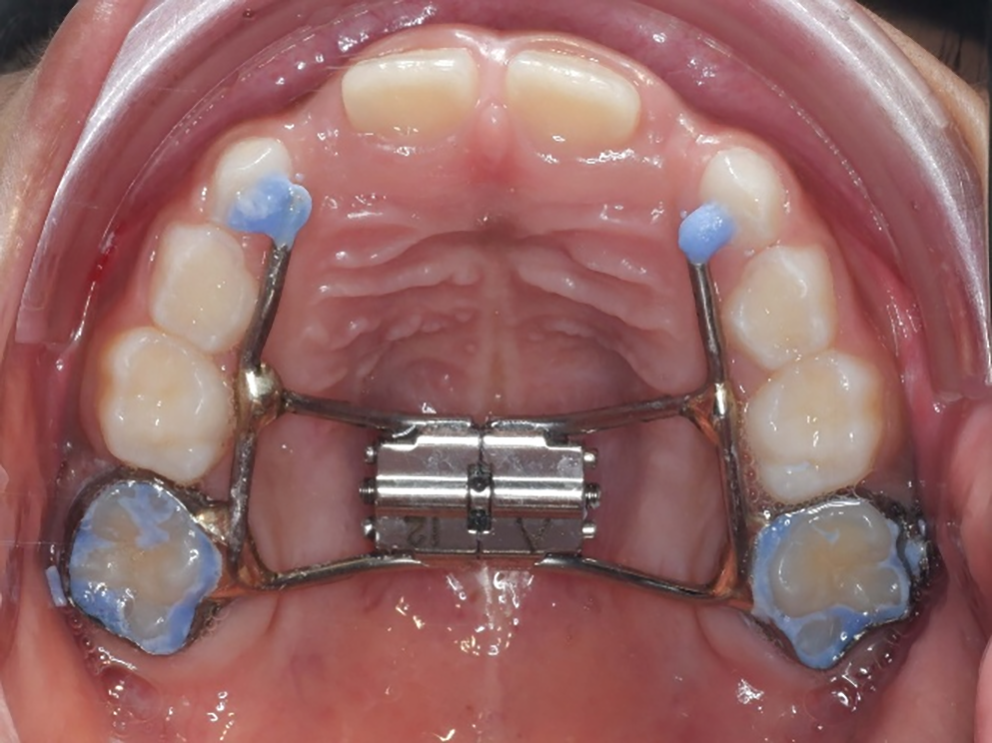 A randomized controlled trial comparing treatment efficacy between rapid maxillary expansion and adenotonsillectomy in pediatric obstructive sleep apnea