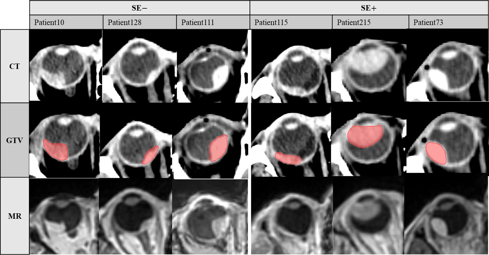 Non-invasive prediction of the secondary enucleation risk in uveal melanoma based on pretreatment CT and MRI prior to stereotactic radiotherapy