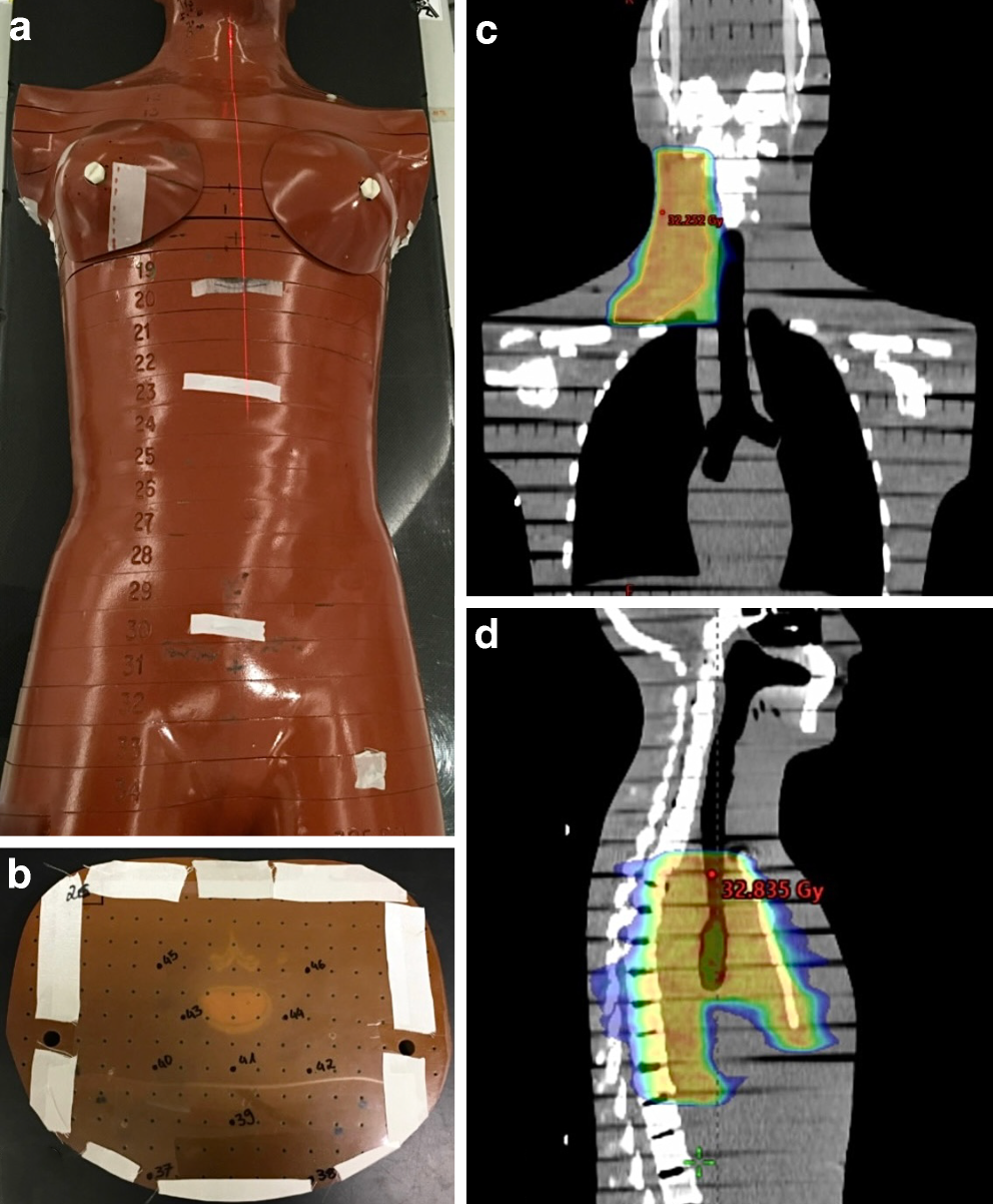 Analysis of fetal dose exposure by modern radiation therapy in pregnant patients with supradiaphragmatic Hodgkin lymphoma—a phantom-based simulation