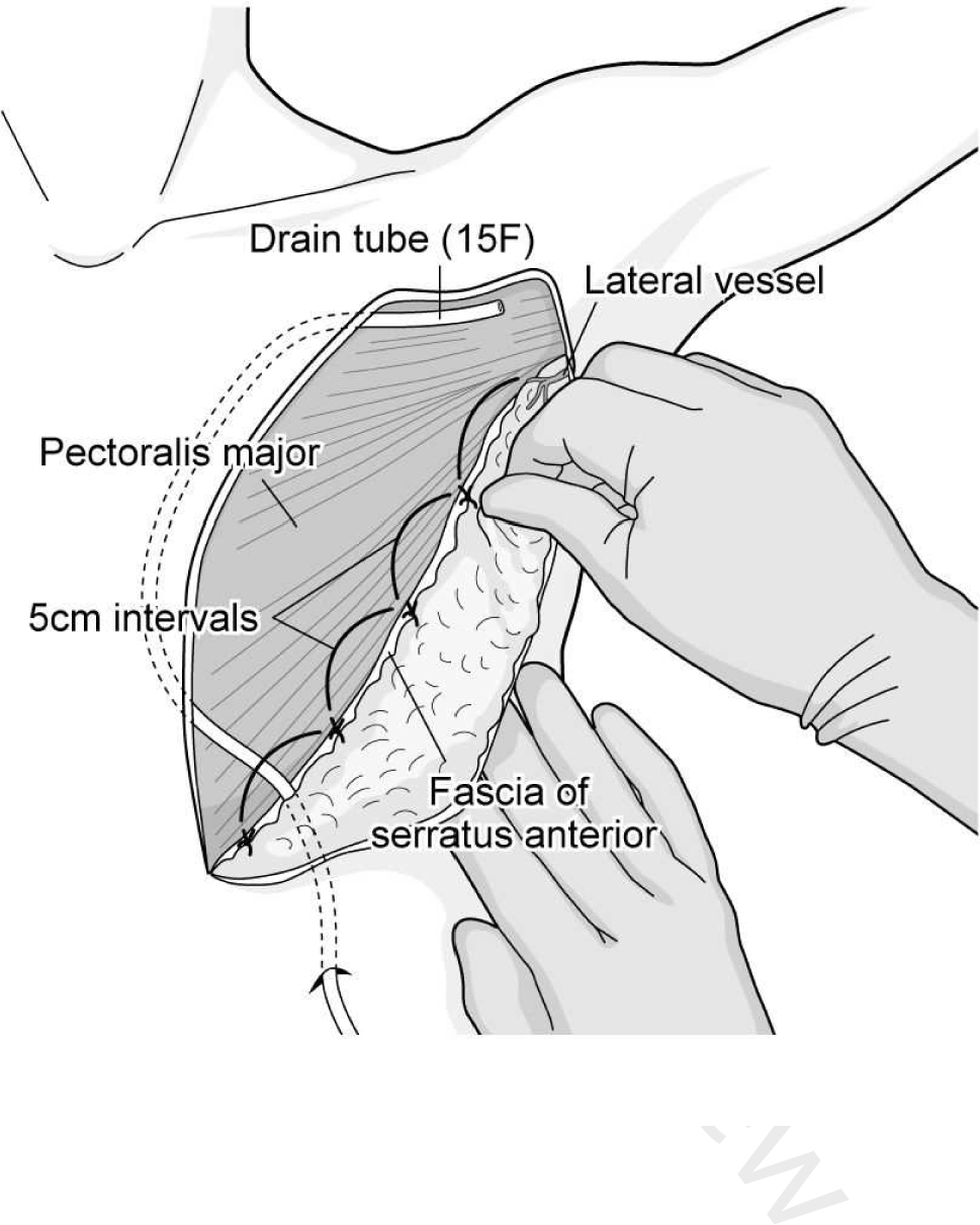 An original flap fixation technique with suturing to the fascia of serratus anterior for reducing seroma after mastectomy: a single-center retrospective study