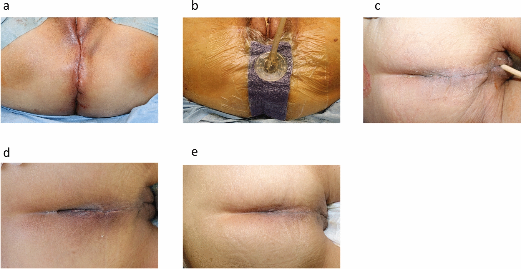 Prophylactic negative pressure wound therapy with Prevena™ to prevent perineal surgical site infection