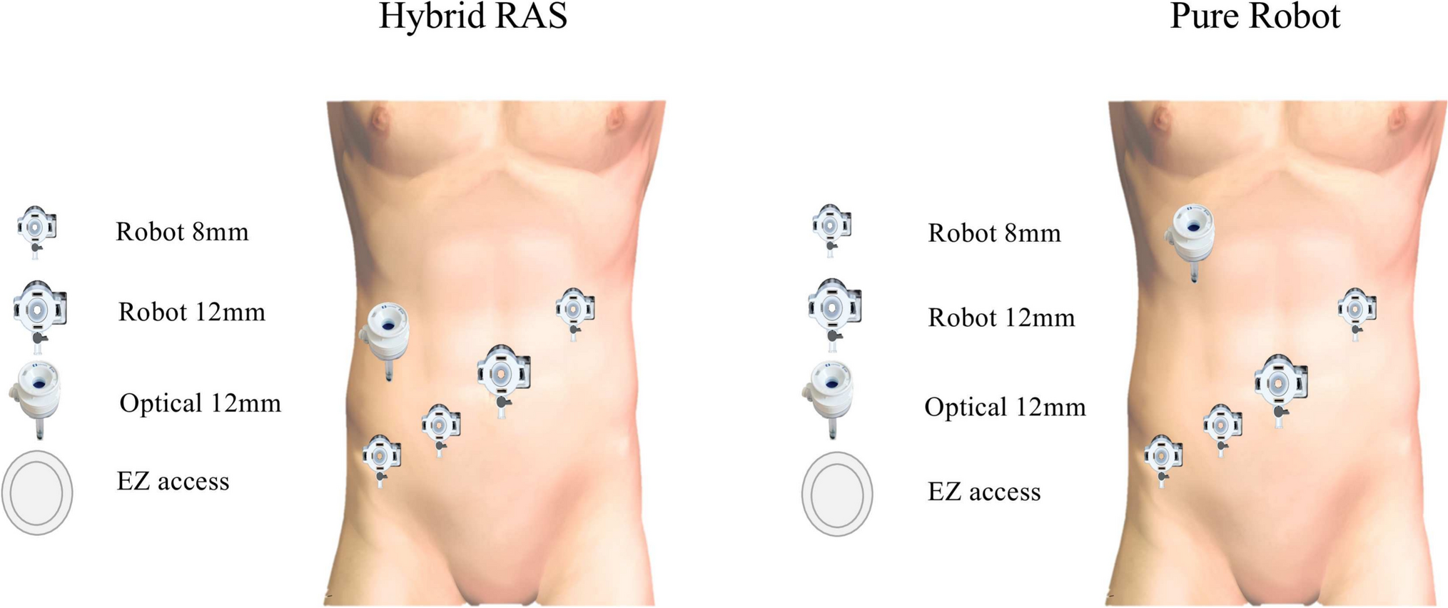 Comprehensive revenue comparison of pure robotic vs. hybrid robotic surgery for sigmoid colon and rectosigmoid cancer