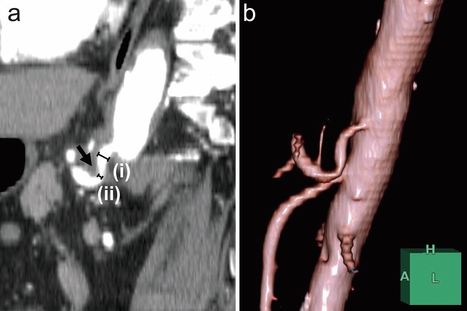 Prevalence of median arcuate ligament syndrome and associated visceral artery aneurysms: Insights from computed tomography radiology reports in a single institution and management strategies