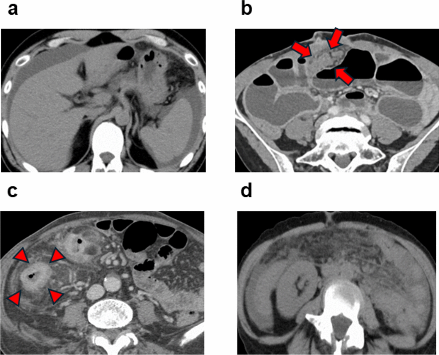 Clinical factors associated with surgical interventions in patients with intestinal obstruction caused by abdominal tuberculosis