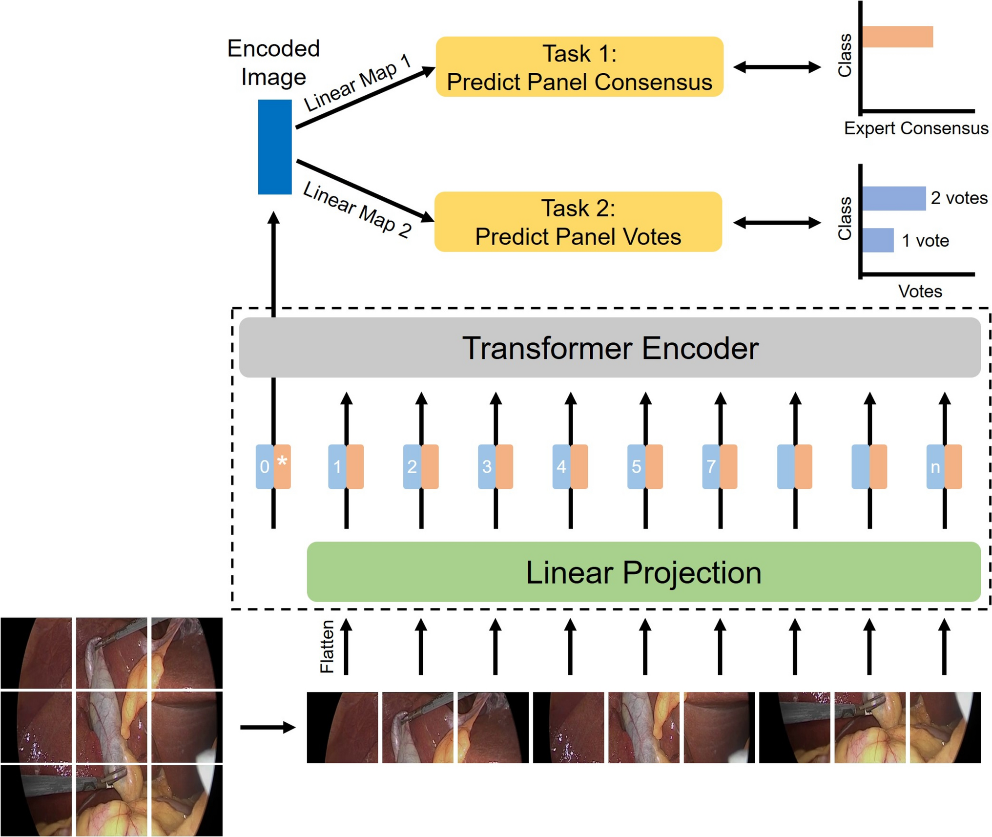 Using artificial intelligence to model expert panel diagnosis of cholecystitis severity