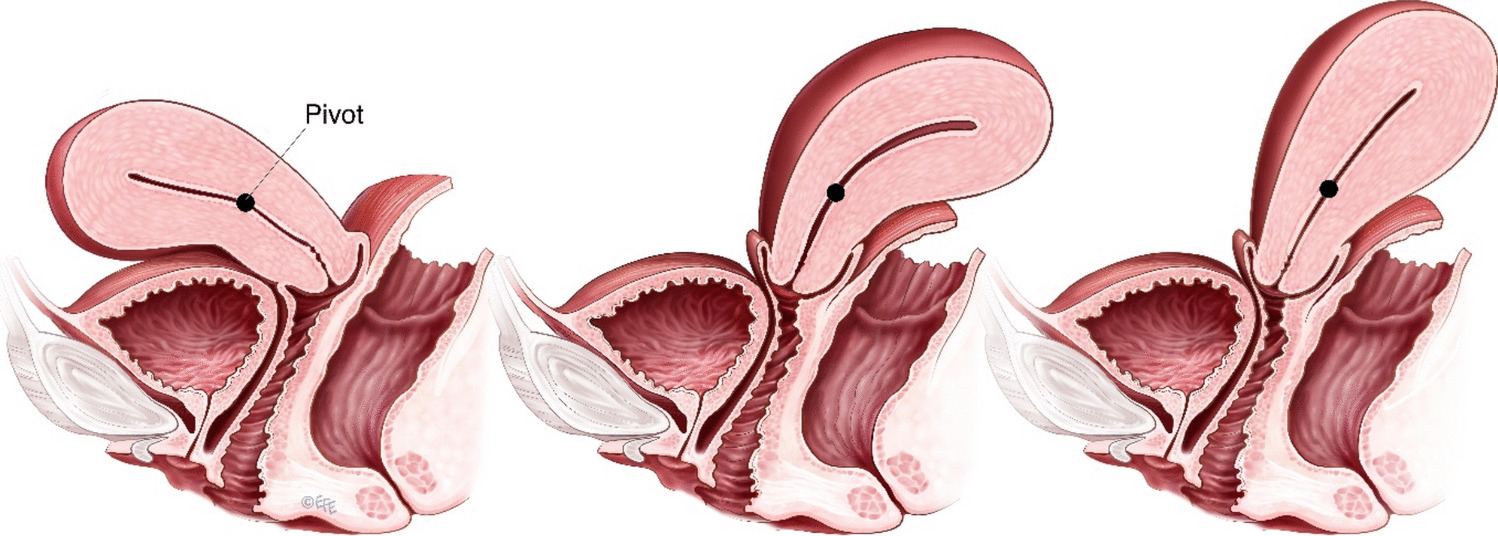 The Retroverted Uterus and Pelvic Floor Dysfunction: 400 BC to 2025 AD