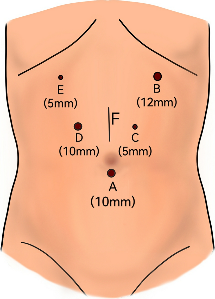 Esophagojejunostomy using a circular stapler after laparoscopic total gastrectomy with pouch suture and multifunctional sealing cap: a simple, safe, and effective anastomosis technique