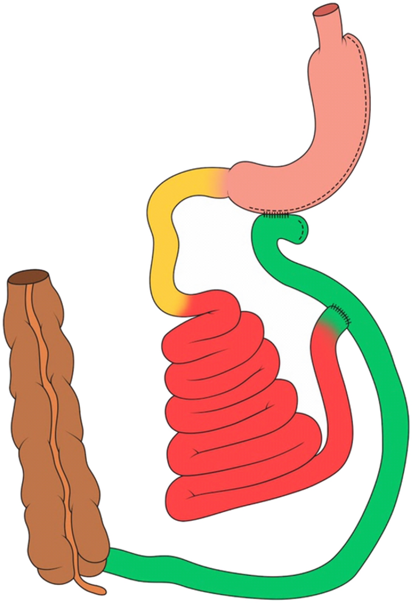 Common channel length and implications to the weight loss