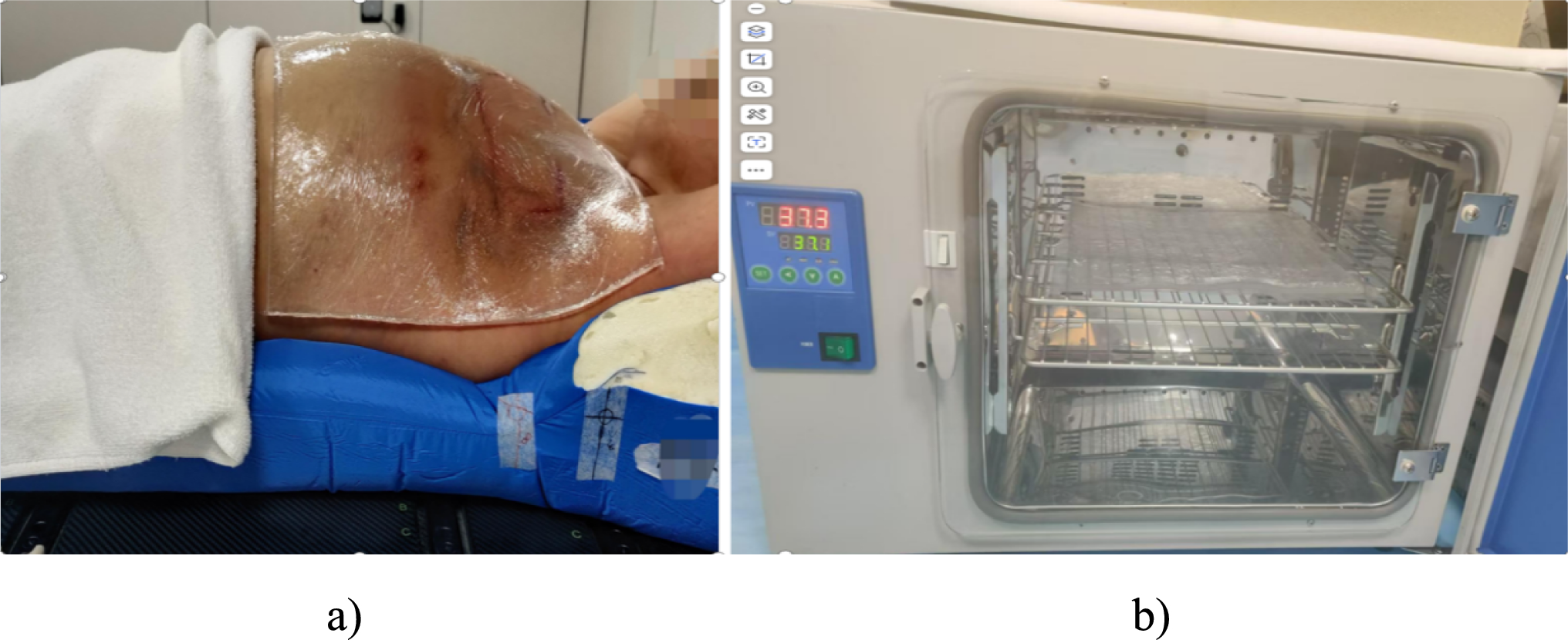 Prospective randomized-controlled trial: efficacy of 37 °C-preheated thermoplastic elastomer (TPE) bolus in postoperative radiotherapy for breast cancer patients