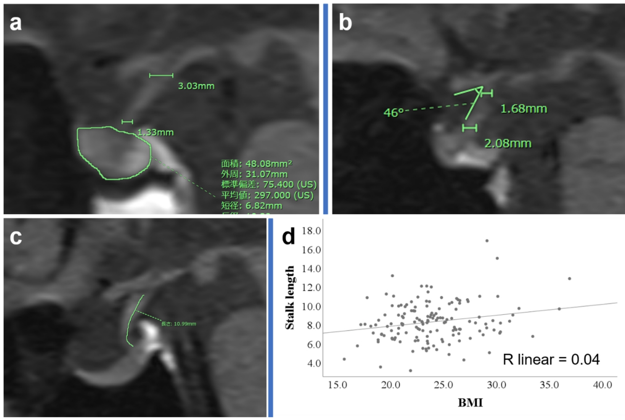 Morphometric study of the pituitary gland and stalk with emphasis on lifestyle factors