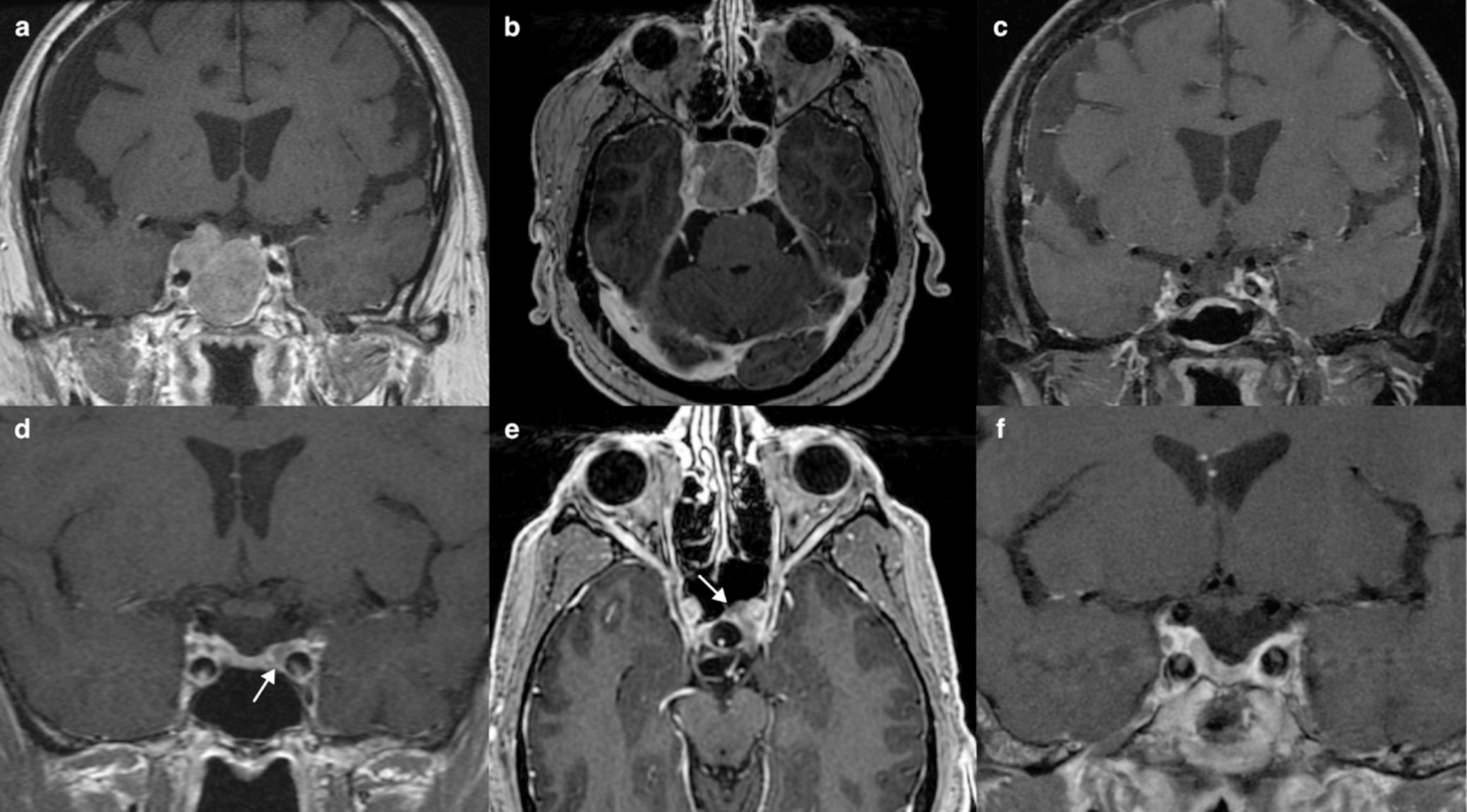 Endoscopic endonasal transcavernous surgery for a contemporary series of 59 prolactinomas