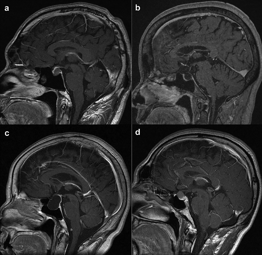High recurrence of rathke’s cleft cysts with anterior-Inferior pituitary displacement despite standard surgical approaches