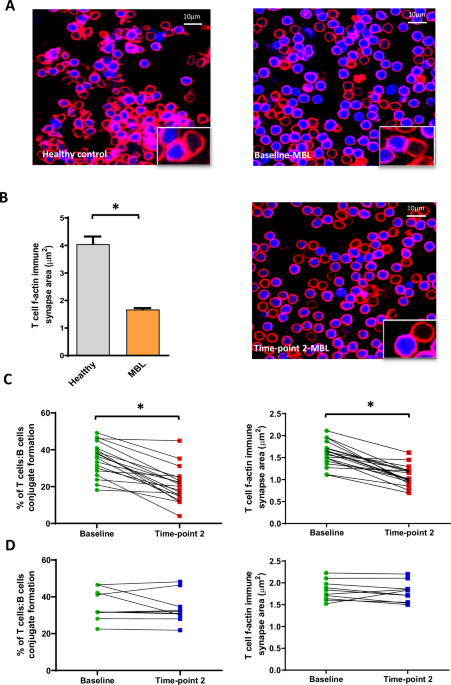 Progressive T cell defects correlate with disease outcome in high-count monoclonal B-cell lymphocytosis