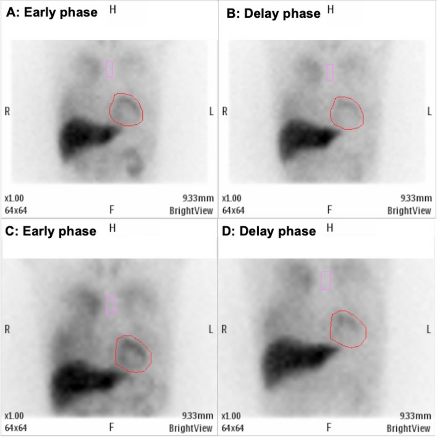 Improvements of cardiac function and metabolic parameters by sodium-glucose cotransporter 2 inhibitors with no significant effects on sympathetic or parasympathetic activity in chronic heart failure