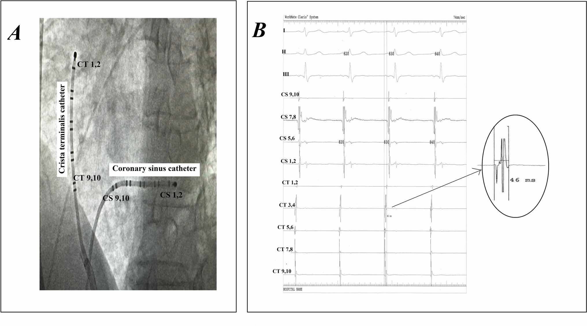 The use of crista terminalis maximum interdeflection time for right–left determining in atrial flutter patients