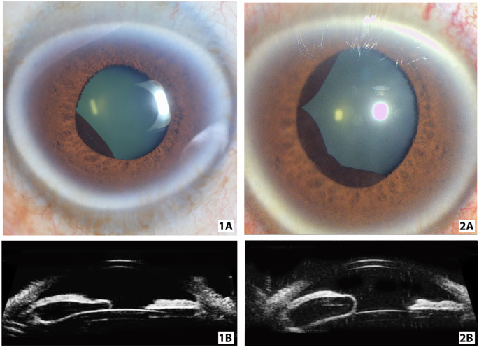 Benign course of a primary iris pigment epithelial cyst