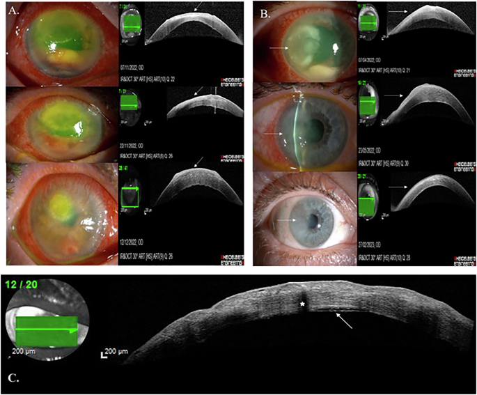 Characterization of different stages of corneal infections using anterior segment OCT to enhance monitoring of progression and response to therapy
