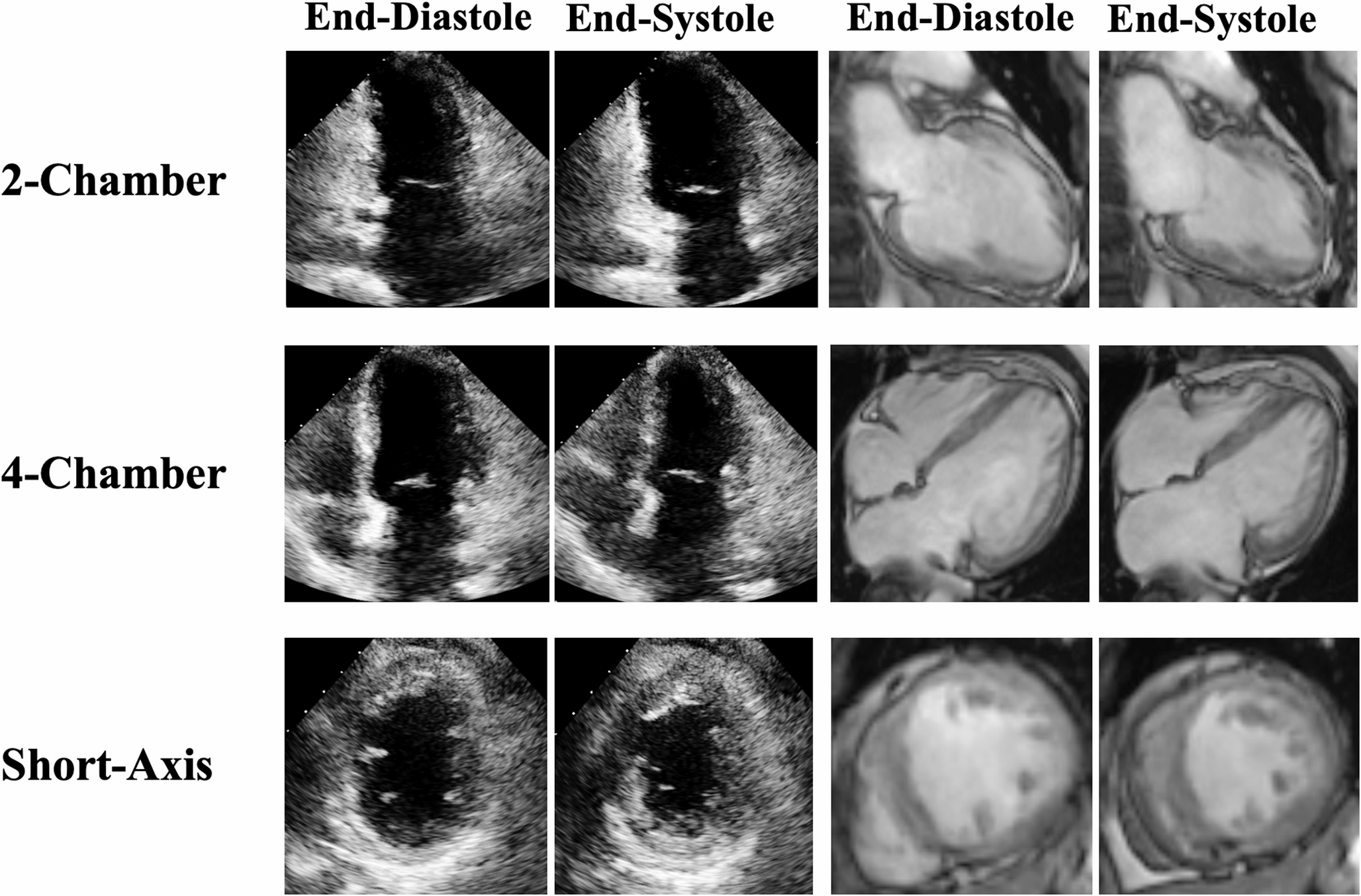 Misclassification of recovery in dilated cardiomyopathy by echocardiography as compared to cardiac MRI