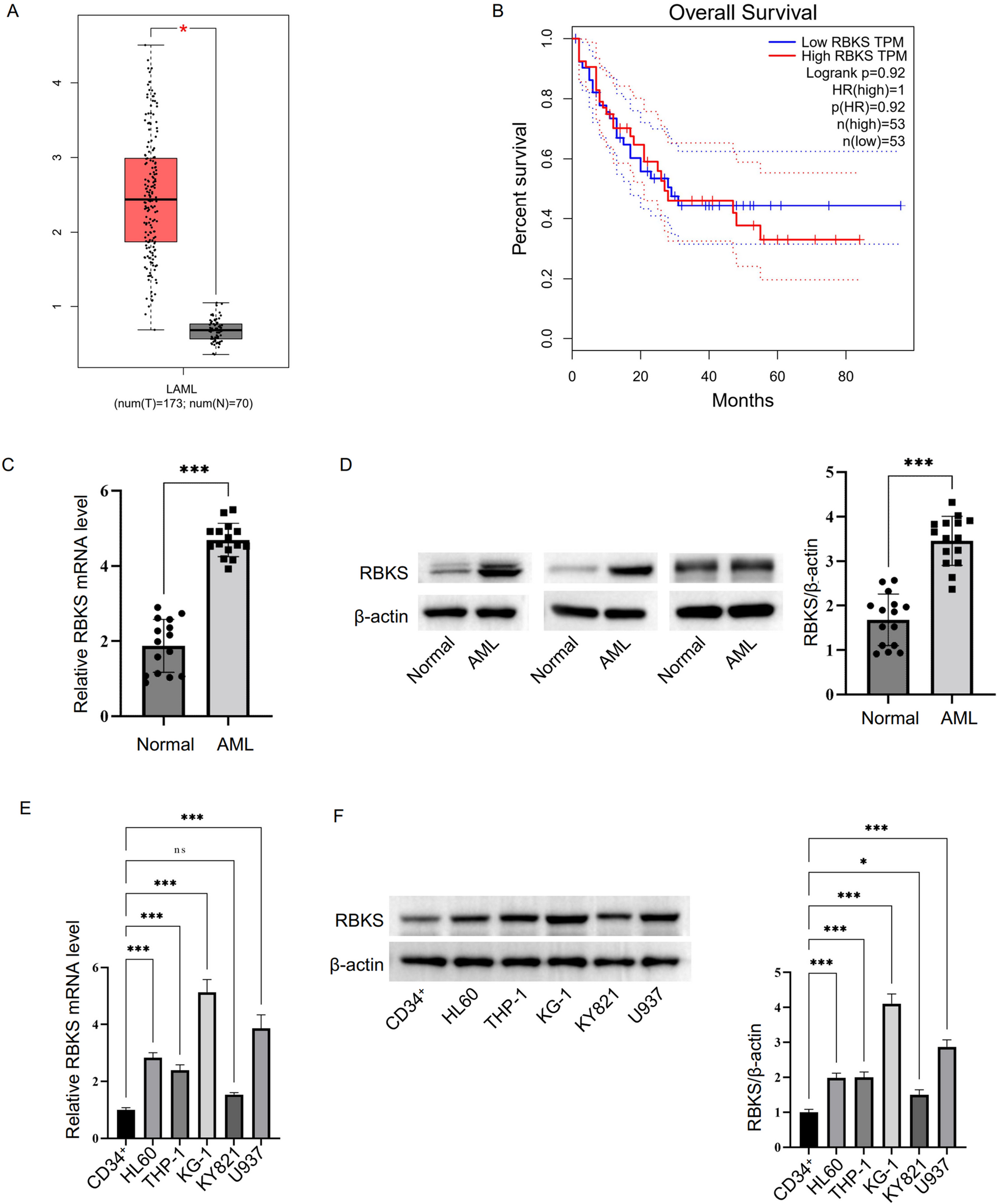 TKT regulates the pentose phosphate pathway via RBKS to promote epithelial-mesenchymal transition during AML progression