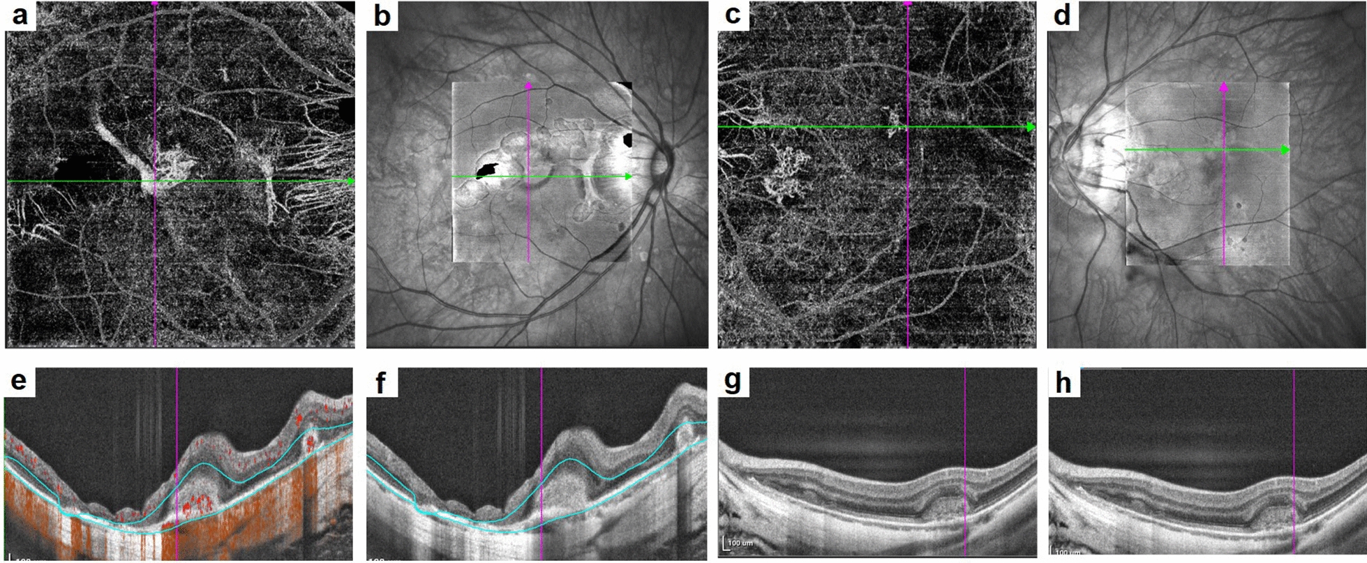 Myopic choroidal neovascularization with dilated choroid vessels is prone to progression into subretinal fibrosis following anti-vascular endothelial growth factor therapy: a retrospective study