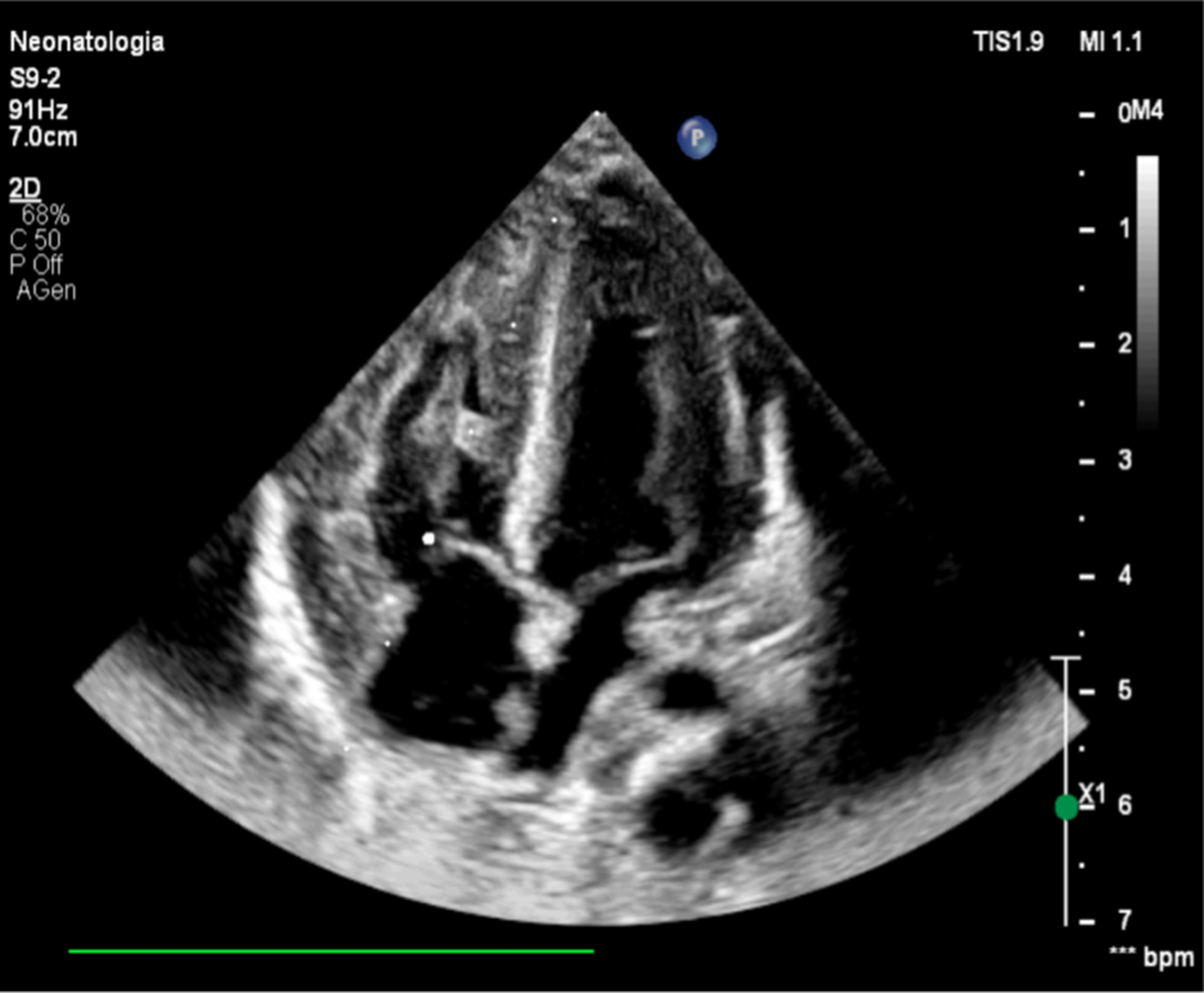 An uncommon case of neonatal asphyxia associated with infantile-onset Pompe disease